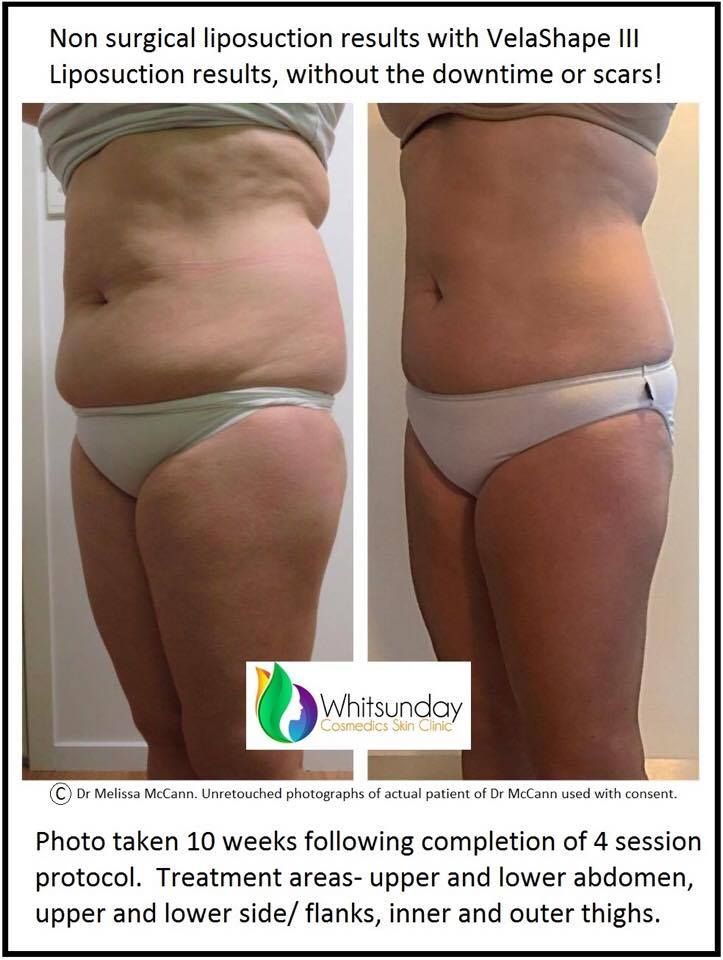 Body Contouring and Cellulite Reduction