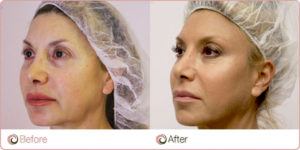 Silhouette-Soft-Lift-Before-After