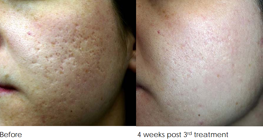 acne scar removal treatment melbourne before and after 3 treatments