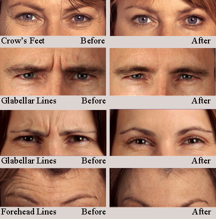 botox before after4pics
