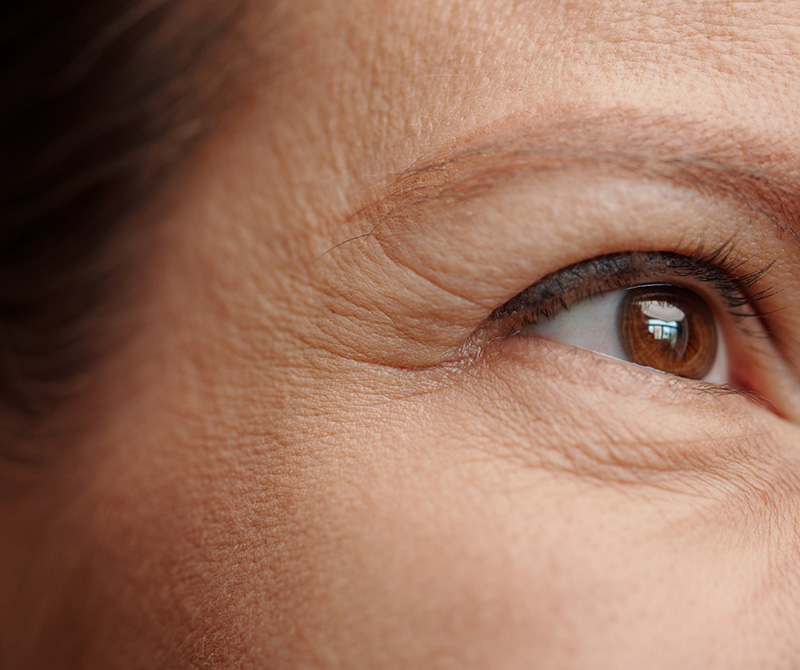 Medical aesthetic - close up of wrinkles around eye
