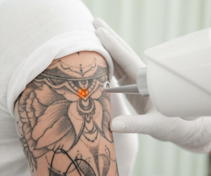 Picosecond laser tattoo removal treatment targeting black ink on a tattooed upper arm.